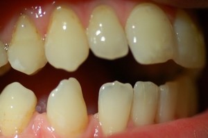Co oznaczają plamki na zębach?