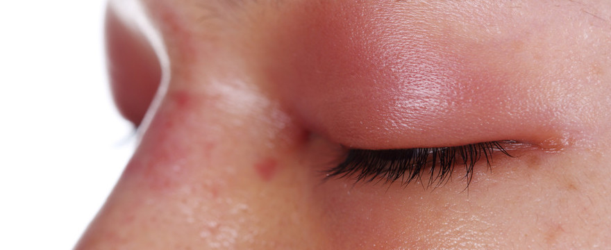 Ból, obrzęki powiek i okolic oczu - zapalenie zatok czy alergia?